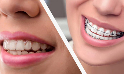 Ortodontia - Invisalign
