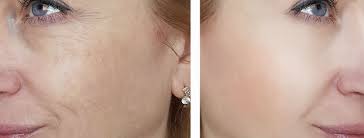 ANTES X DEPOIS, PODE?