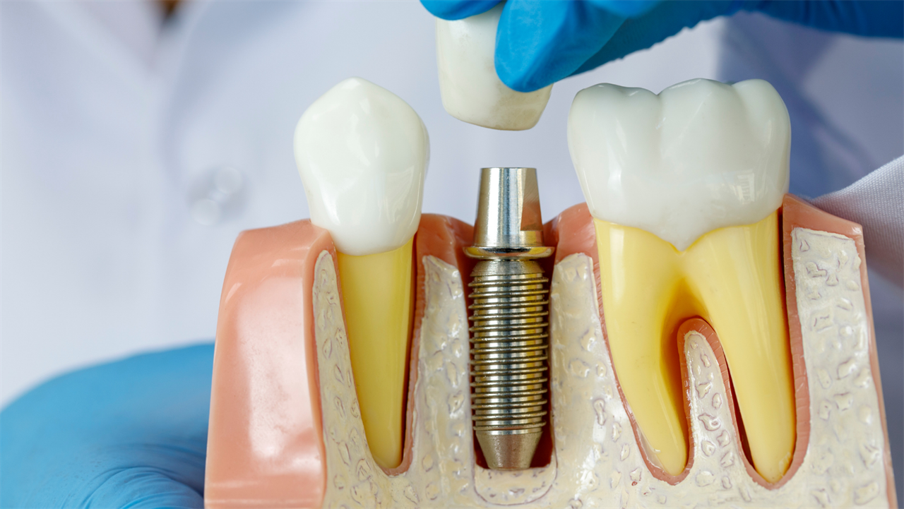 IMPLANTES DENTÁRIOS - PRÓTESE PROTOCOLO